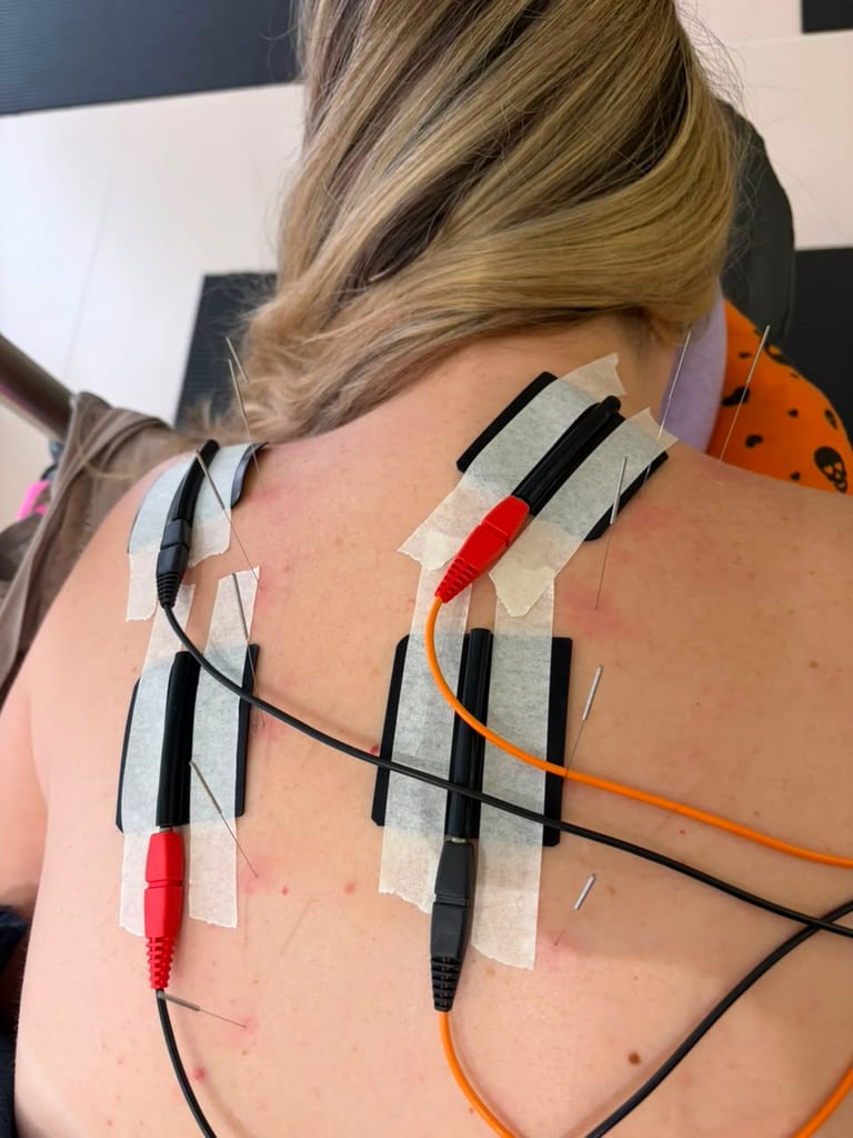 Procedimento de dry needling