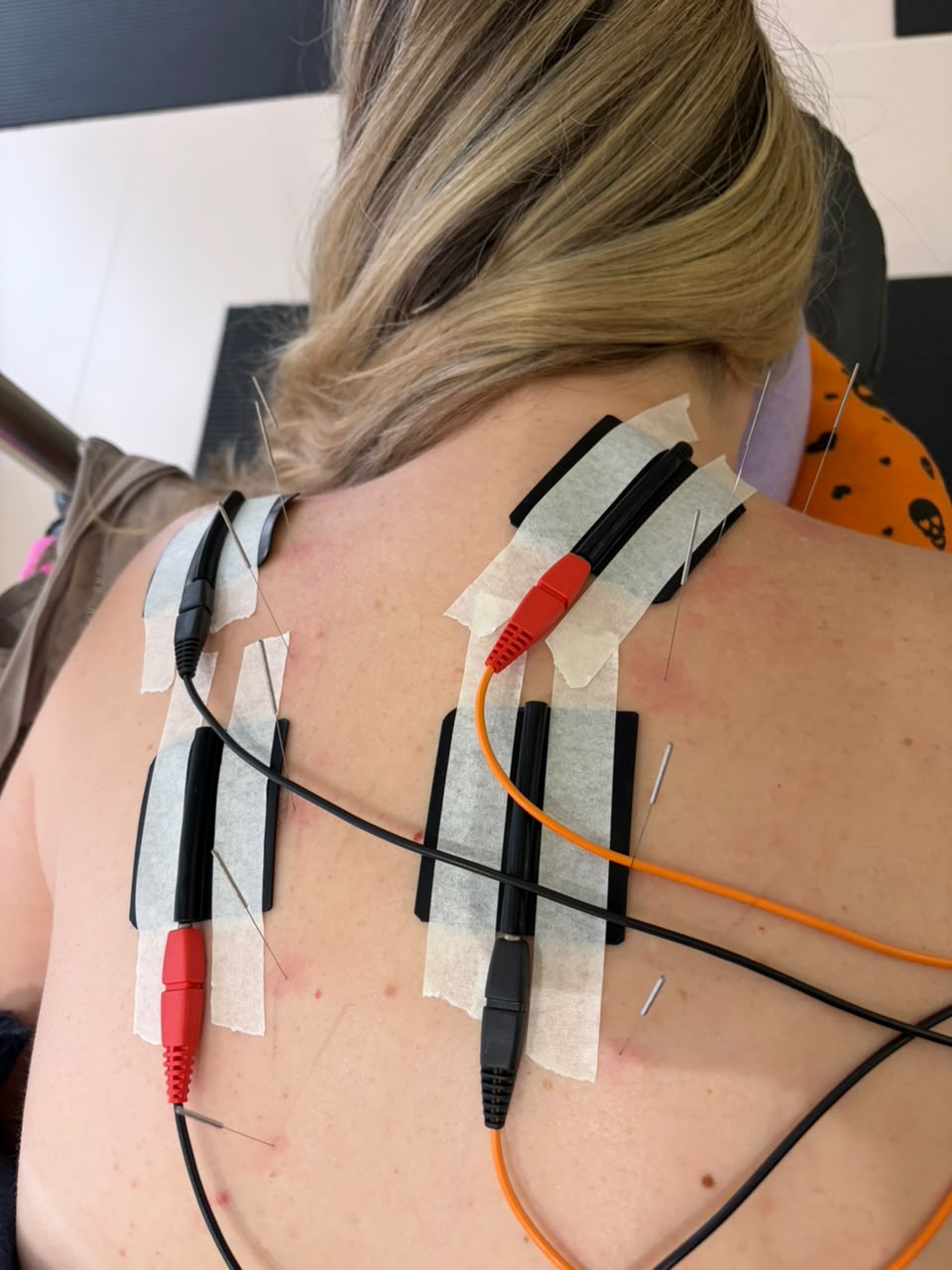 Procedimento de dry needling